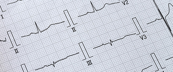 24時間心電図検査